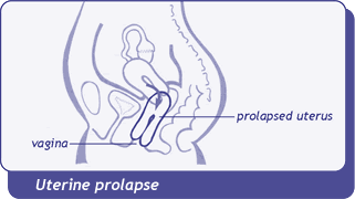 diagram of uterine prolapse