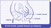 diagram of enterocele